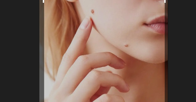 Eradicating Warts with Apple Cider Vinegar: Is It a Secure Technique?